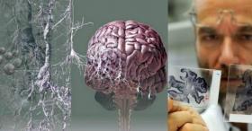 21 вересня  2021 року у світі відзначають Всесвітній день боротьби з хворобою Альцгеймера